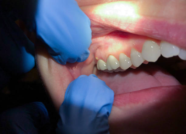 Best Urgent Care for Lost Fillings or Crowns in Malden, MO